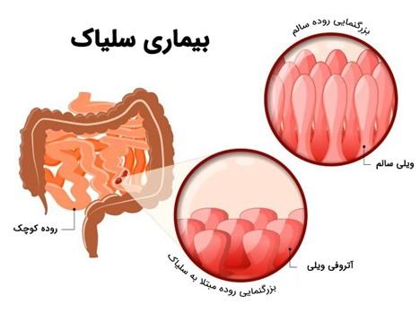 نگاهی به بیماری سلیاک